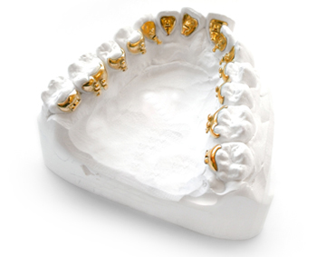 Lingualbrackets Lingualbrackets