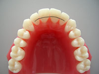 Permanenter Retainer Permanenter Retainer