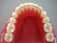 Permanenter Retainer Permanenter Retainer