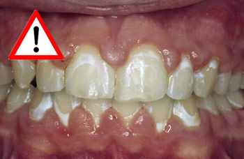 Kieferorthop�dische Prophylaxe Kieferorthop�dische Prophylaxe
