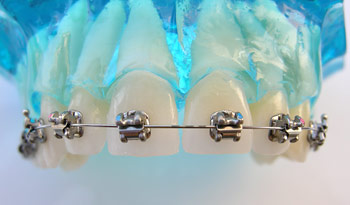 Selbstligierende Brackets Selbstligierende Brackets