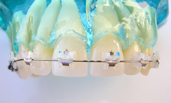 Selbstligierende Keramikbrackets Selbstligierende Keramikbrackets